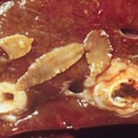 Liver Fluke